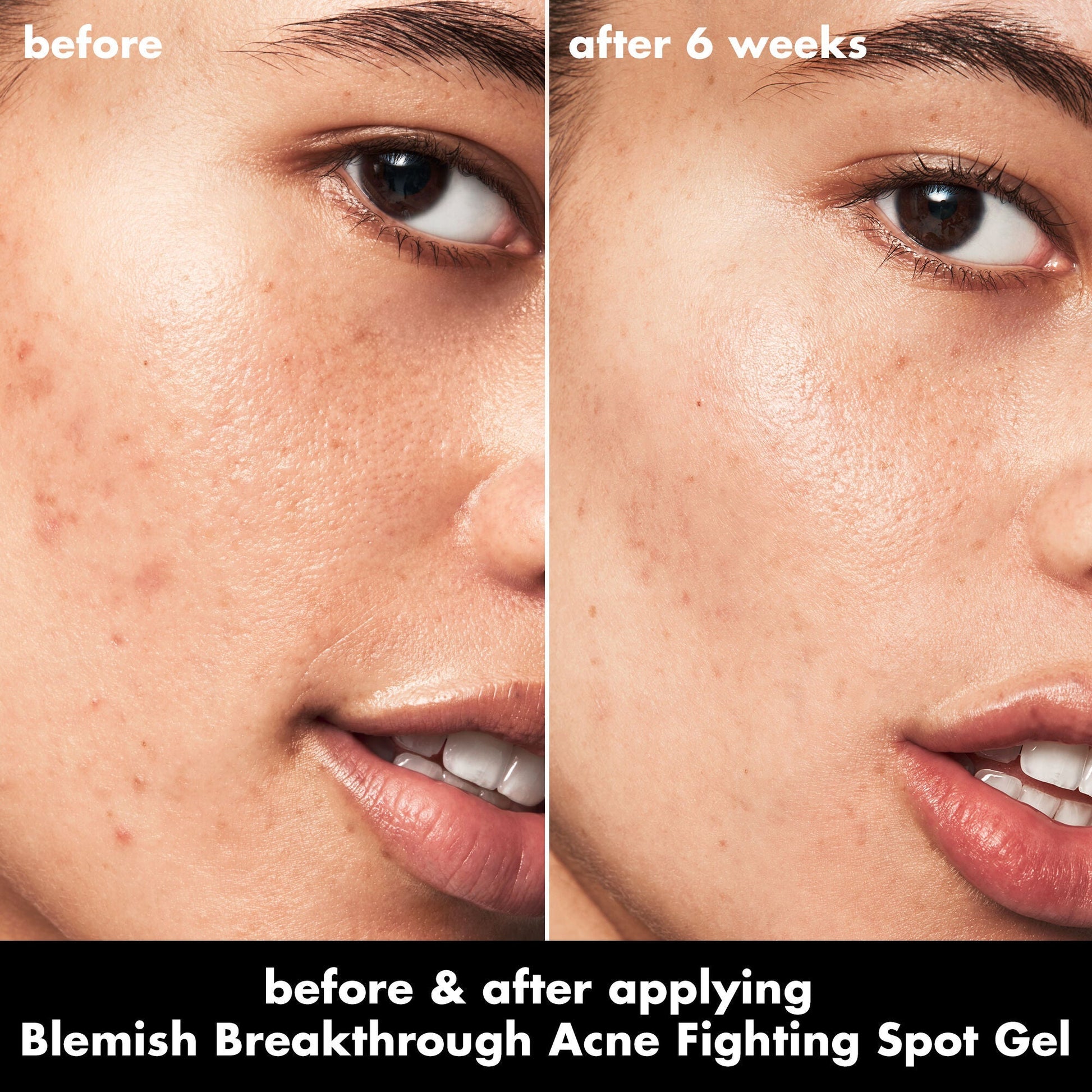 blemish-breakthrough-acne-fighting-spot-gel-b7 0326_EDU_BB_SpotGel_BA_ISABELLA.jpg