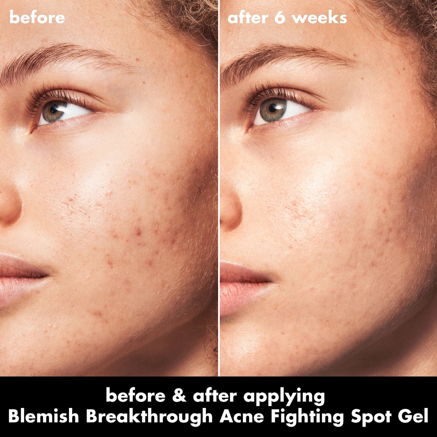 blemish-breakthrough-acne-fighting-spot-gel-b7 0326_EDU_BB_SpotGel_BA_MARLEY.jpg
