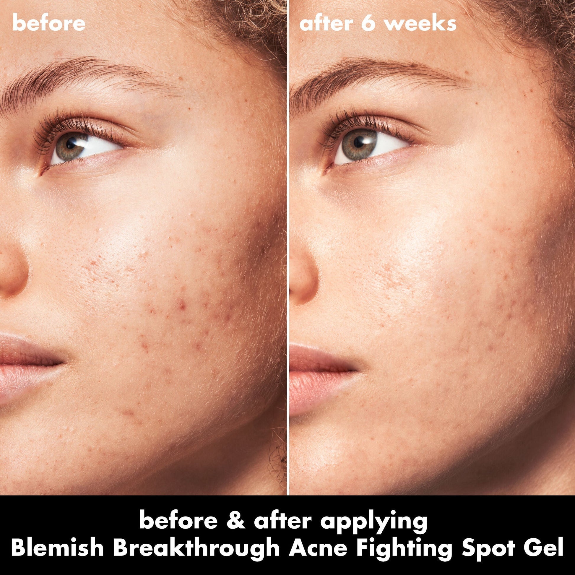 blemish-breakthrough-acne-fighting-spot-gel-b7 0326_EDU_BB_SpotGel_BA_MARLEY.jpg