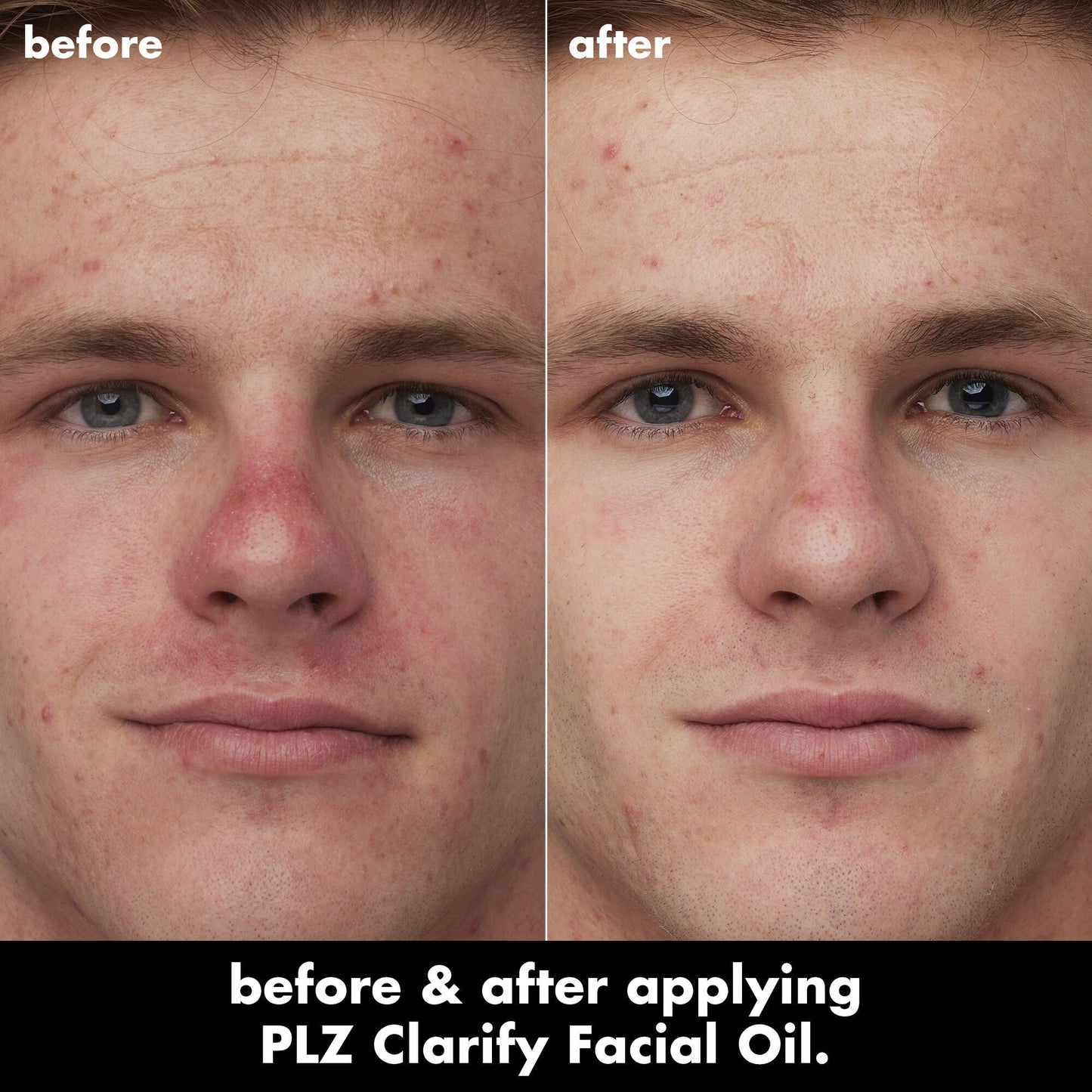 plz-clarify-facial-oil-n5 0326_EDU_PlzClarify_BA_Caleb.jpg