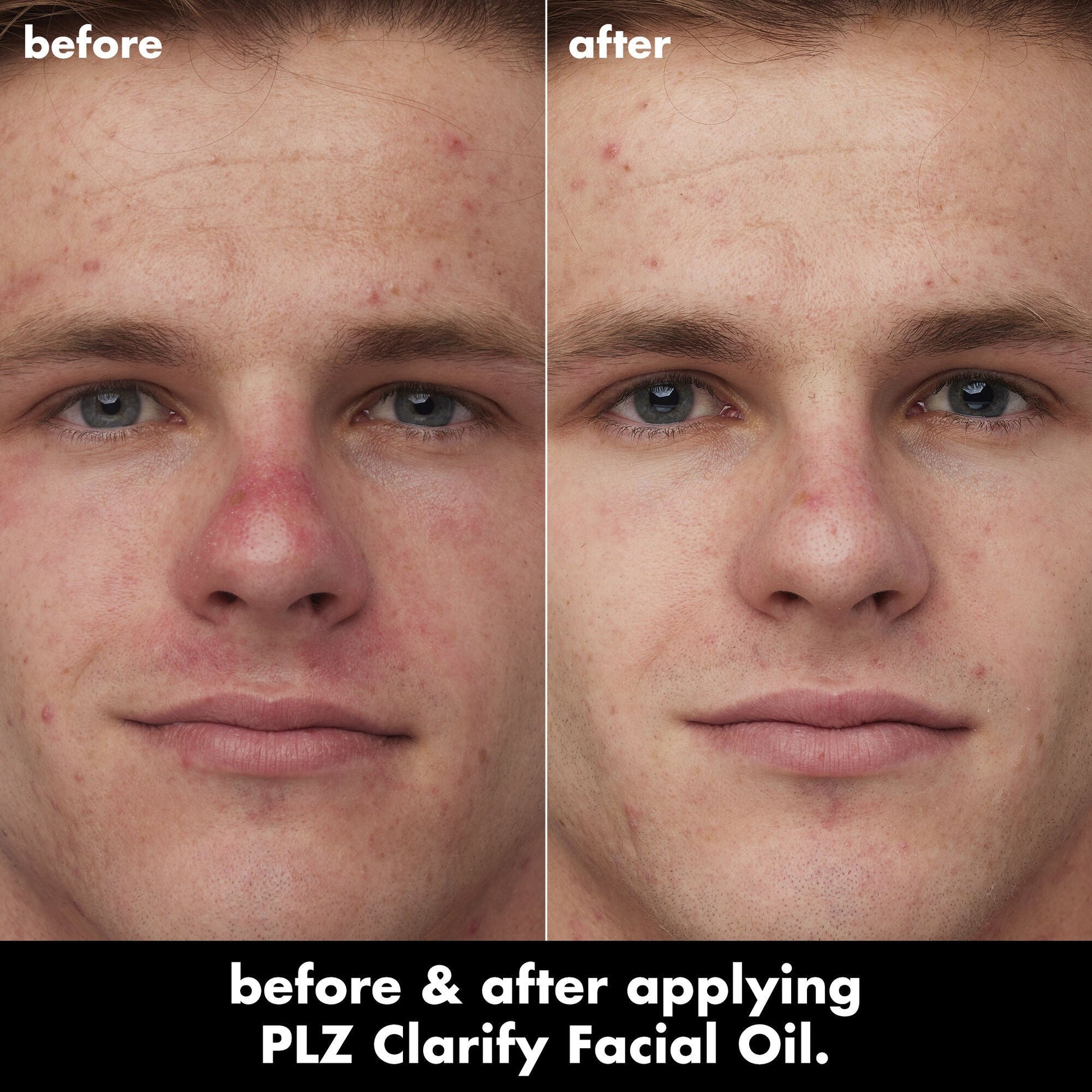 plz-clarify-facial-oil-n5 0326_EDU_PlzClarify_BA_Caleb.jpg