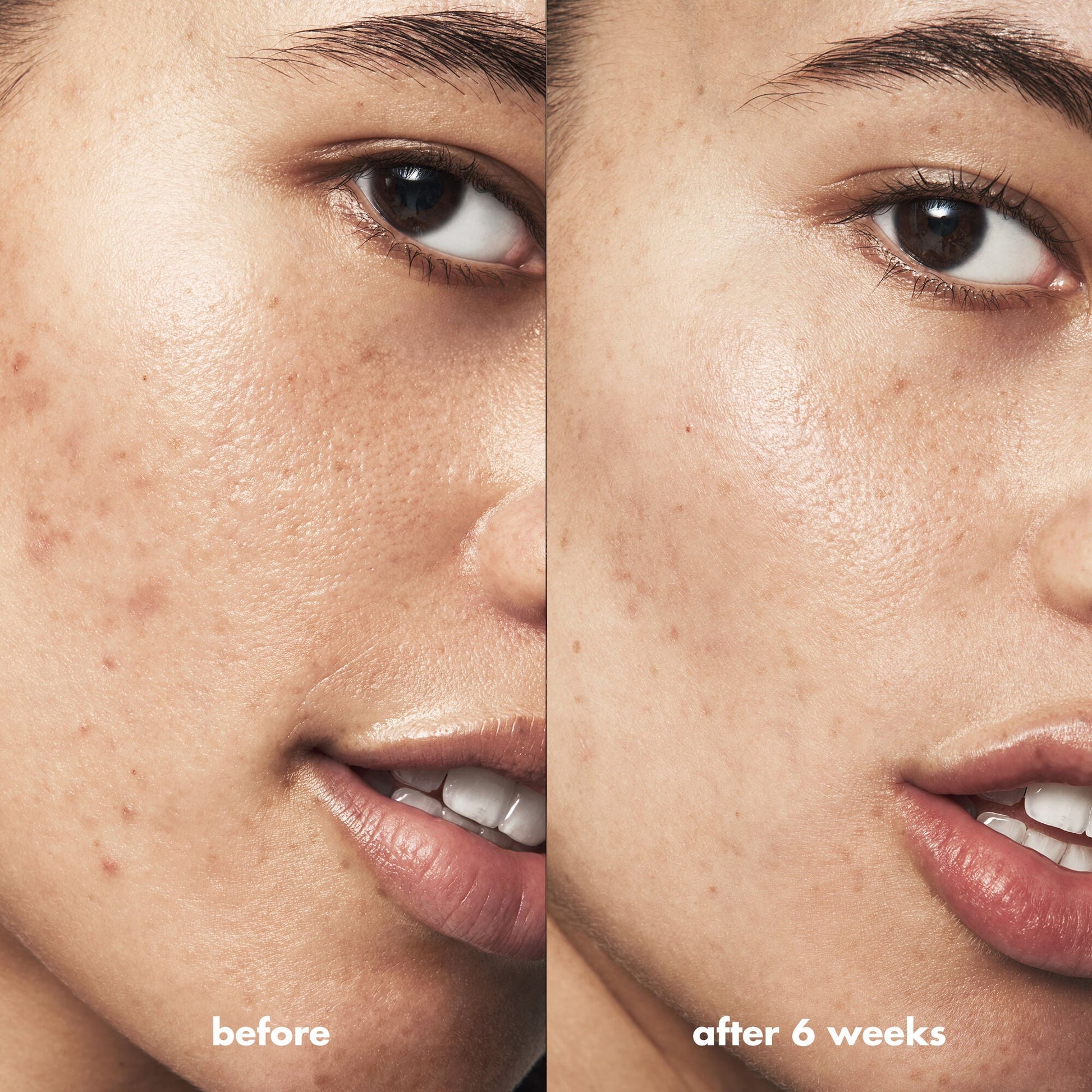 blemish-breakthrough-acne-calming-water-cream-a9 Acne_PDP_Isabella_Before_After_84ce713a-22d2-4bb9-aad7-445c7b27b1c9.jpg
