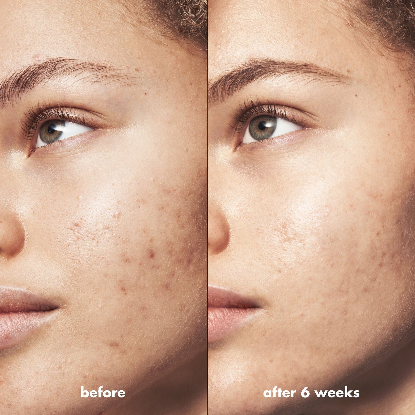 blemish-breakthrough-triple-acid-resurfacing-serum-l0 Acne_PDP_Marley_Before_After_1a95cac5-0af6-43b6-a936-d0bacbdec0bf.jpg